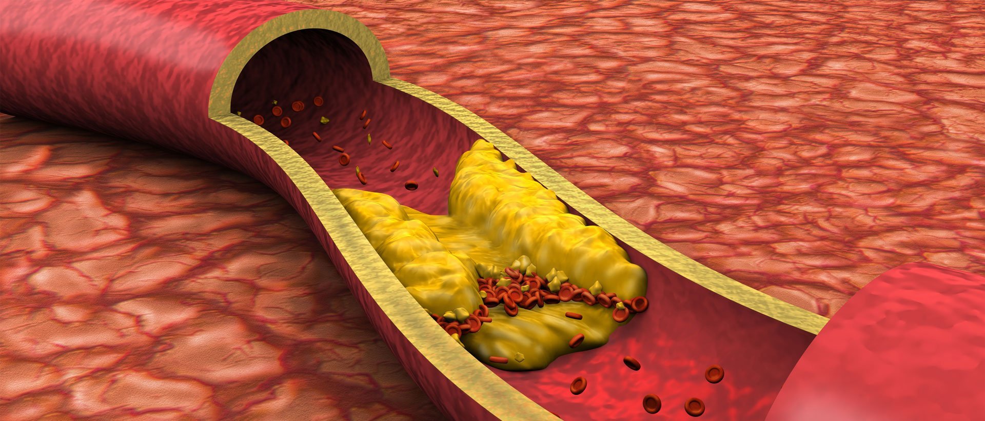 Arteriosklerose – Arterielle Ablagerungen